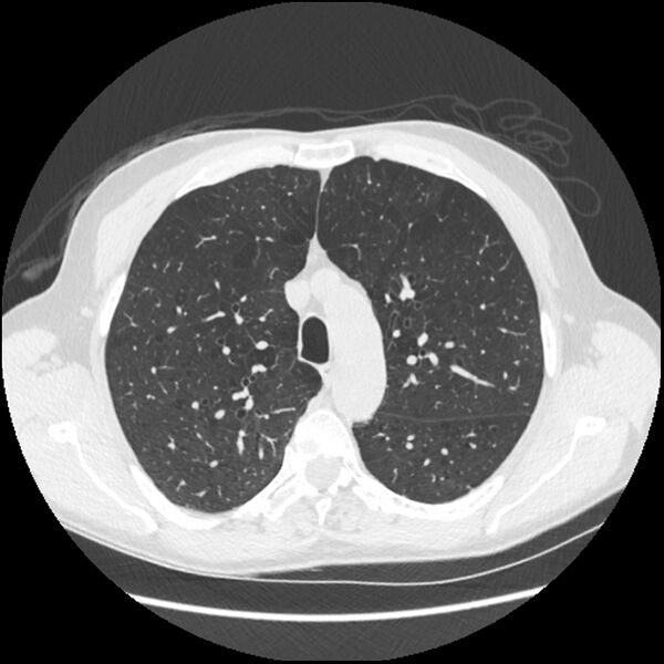 File:Alpha-1-antitrypsin deficiency (Radiopaedia 40993-43722 Axial lung window 67).jpg