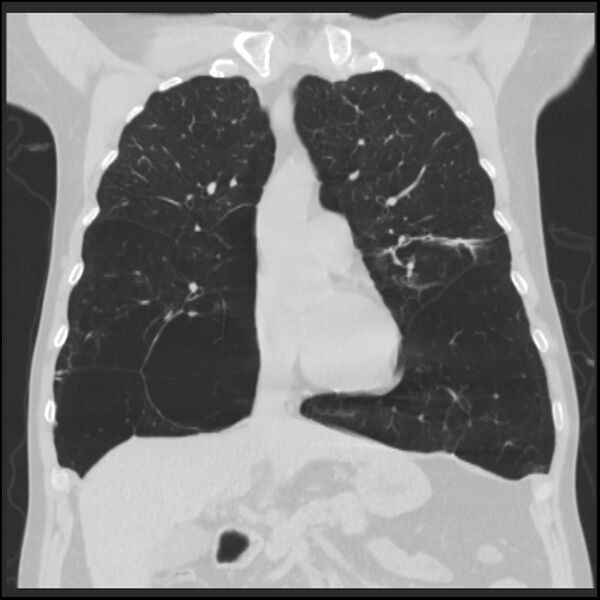 File:Alpha-1-antitrypsin deficiency (Radiopaedia 40993-43722 Coronal lung window 36).jpg