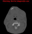 Ameloblastoma (Radiopaedia 13276-13280 Axial non-contrast 4).jpg