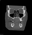 Ameloblastoma (Radiopaedia 18115-17901 Axial bone window 25).jpg