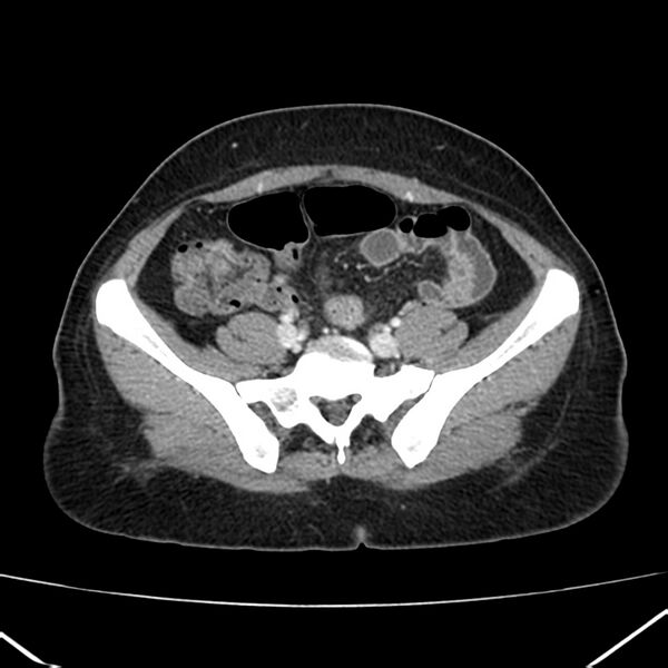 File:Ampullary tumor (Radiopaedia 22787-22816 C 50).jpg
