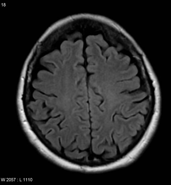 File:Amyotrophic lateral sclerosis (Radiopaedia 5373-7134 Axial FLAIR 18).jpg