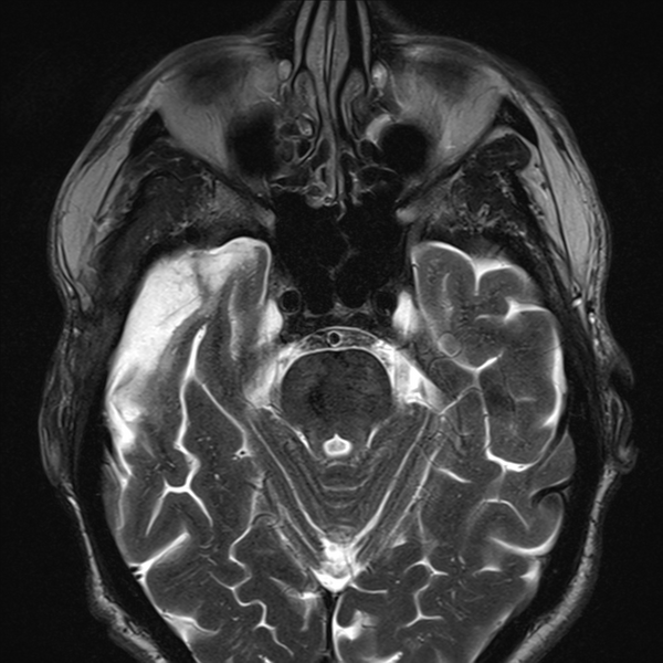 File:Anaplastic meningioma with recurrence (Radiopaedia 34452-35788 Axial T2 4).png