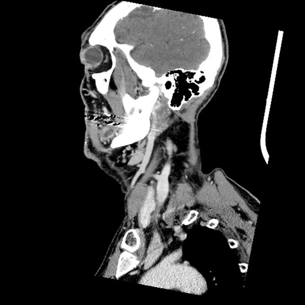 File:Anaplastic thyroid carcinoma (Radiopaedia 79087-92034 C 71).jpg