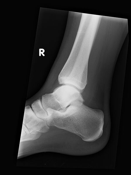 File:Ankle fracture - Weber B (Radiopaedia 46843-51371 Lateral 1).jpg