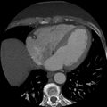Anomalous origin of left circumflex artery from right coronary sinus (Radiopaedia 72563-83117 A 21).jpg
