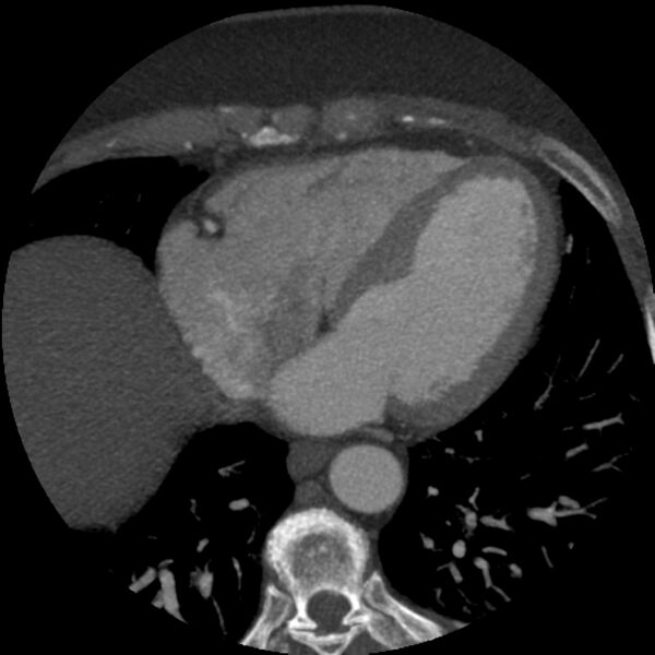 File:Anomalous origin of left circumflex artery from right coronary sinus (Radiopaedia 72563-83117 A 21).jpg