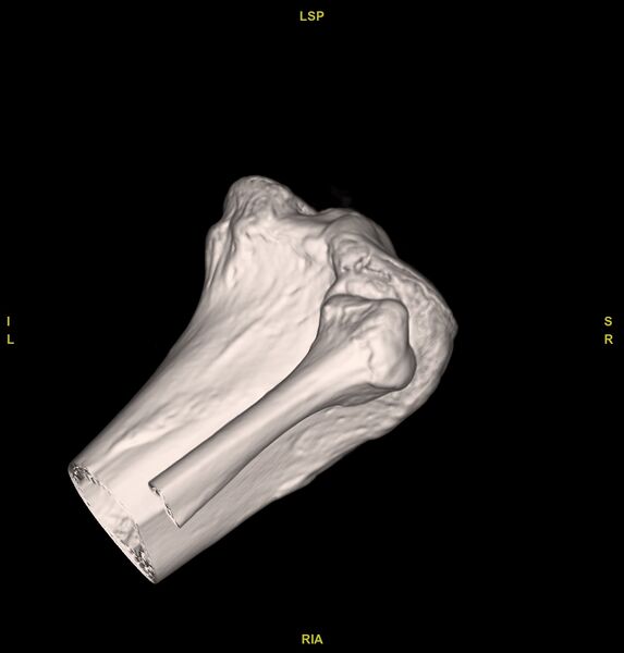File:Anterior cruciate ligament avulsion fracture (Radiopaedia 58939-66194 VRT 9).jpg