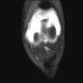 Anterior cruciate ligament tear - pediatric (Radiopaedia 62152-70260 Coronal PD fat sat 23).jpg