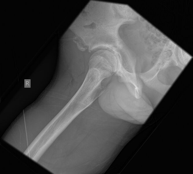 File:Anterior inferior iliac spine avulsion fracture - subacute (Radiopaedia 63151-71671 Lateral 1).jpg