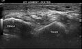 Anterior talofibular ligament injury (Radiopaedia 53338-59320 A 6).jpg