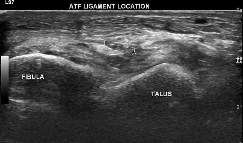 File:Anterior talofibular ligament injury (Radiopaedia 53338-59320 A 6).jpg