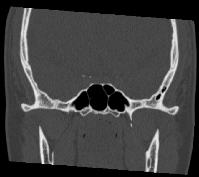 File:Antrochoanal polyp (Radiopaedia 21894-21868 Coronal bone window 30).jpg
