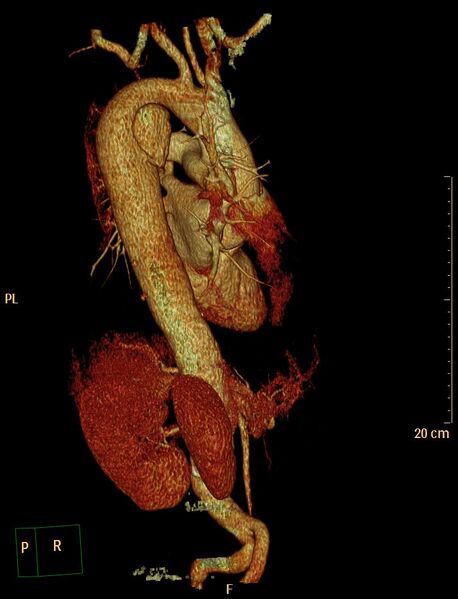 File:Aortic aneurysm and penetrating ulcer (Radiopaedia 23590-23704 3D reconstruction 10).jpg