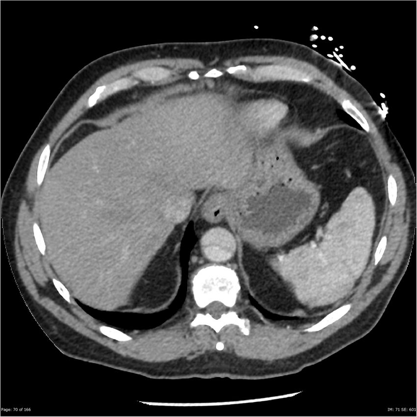 Aortic dissection- Stanford A (Radiopaedia 37759-39664 A 61).jpg