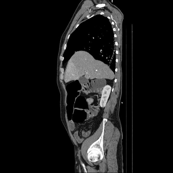 File:Aortic dissection- Stanford type A (Radiopaedia 22085-22085 D 15).jpg