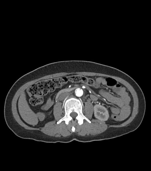 File:Aortic dissection with renal ischemia (Radiopaedia 76573-88338 A 77).jpg