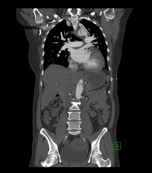 File:Aortic dissection with renal ischemia (Radiopaedia 76573-88338 C 15).jpg