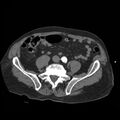 Aortic dissection with rupture into pericardium (Radiopaedia 12384-12647 A 73).jpg