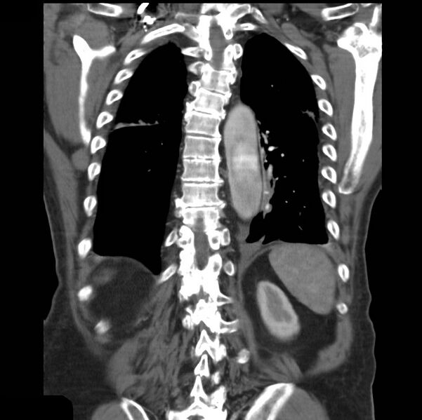 File:Aortic dissection with rupture into pericardium (Radiopaedia 12384-12647 B 35).jpg