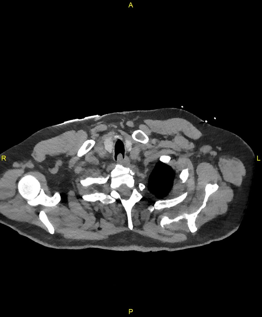 Aortic rupture (Radiopaedia 88822-105594 Axial non-contrast 9).jpg