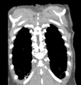 Aortic valve non-coronary cusp thrombus (Radiopaedia 55661-62189 C 69).png