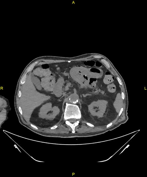 File:Aortoenteric fistula (Radiopaedia 84308-99603 Axial non-contrast 94).jpg