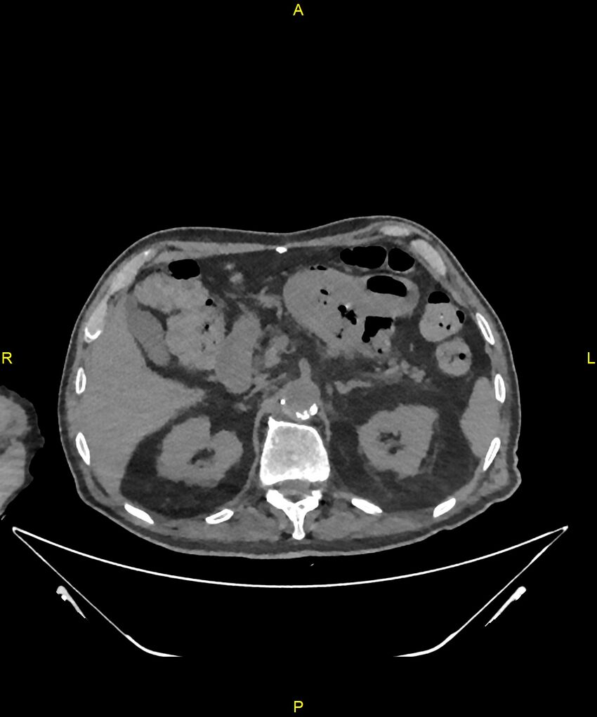 Aortoenteric fistula (Radiopaedia 84308-99603 Axial non-contrast 94).jpg