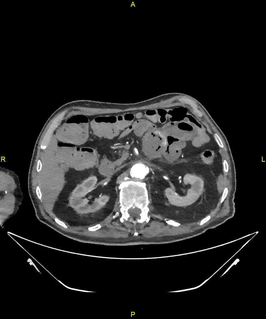 Aortoenteric fistula (Radiopaedia 84308-99603 B 106).jpg