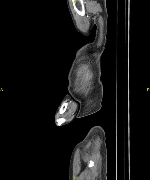 File:Aortoenteric fistula (Radiopaedia 84308-99603 C 10).jpg
