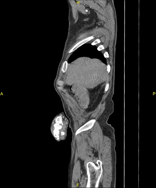 File:Aortoenteric fistula (Radiopaedia 84308-99603 C 40).jpg