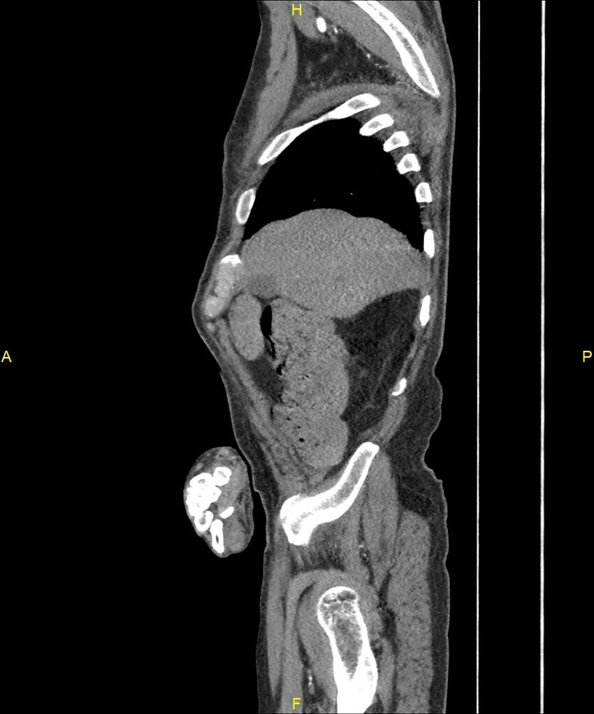 Aortoenteric fistula (Radiopaedia 84308-99603 C 54).jpg
