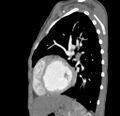 Aortopulmonary window, interrupted aortic arch and large PDA giving the descending aorta (Radiopaedia 35573-37074 C 39).jpg