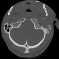 Apical pneumothorax on cervical spine CT (Radiopaedia 45343-49368 Axial bone window 6).jpg