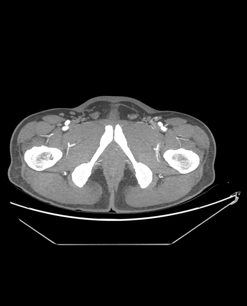 Aplastic posterior tibial arteries (Radiopaedia 84021-99249 A 106).jpg