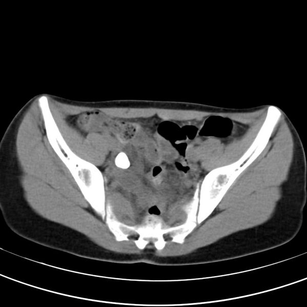 File:Appendicitis and incidental bicornuate uterus (Radiopaedia 22833-22853 Axial non-contrast 37).jpg