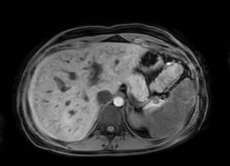 File:Appendicitis in gravida (MRI) (Radiopaedia 89433-106395 Axial DIXON 22).jpg