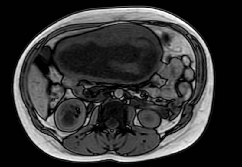 File:Appendicitis in gravida (MRI) (Radiopaedia 89433-106395 D 28).jpg