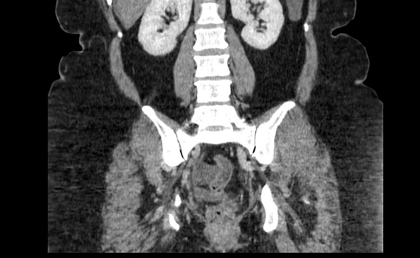 Appendix mucocele (Radiopaedia 41222-44033 B 66).jpg