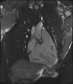 Arrhythmogenic right ventricular cardiomyopathy (Radiopaedia 57972-64966 CINE R2 SSFP 56).jpg