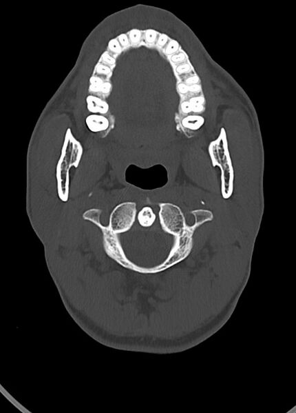 File:Arrow injury to the head (Radiopaedia 75266-86388 Axial bone window 34).jpg