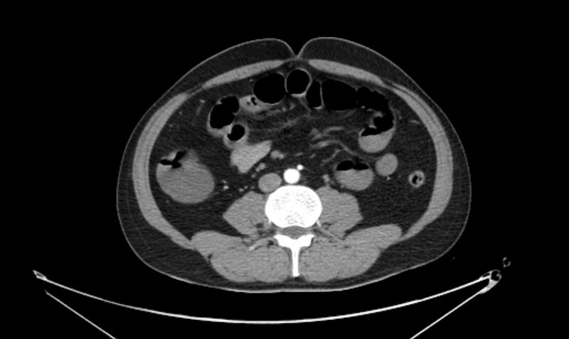 File:Arterial occlusive mesenteric ischemia (Radiopaedia 84641-100060 A 75).jpg