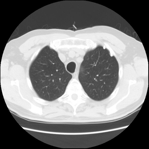 File:Asbestos-related pleural plaques (Radiopaedia 39069-41255 Axial lung window 15).jpg
