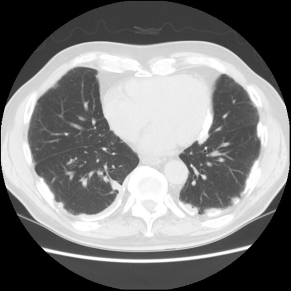 File:Asbestos-related pleural plaques (Radiopaedia 39069-41255 Axial lung window 49).jpg