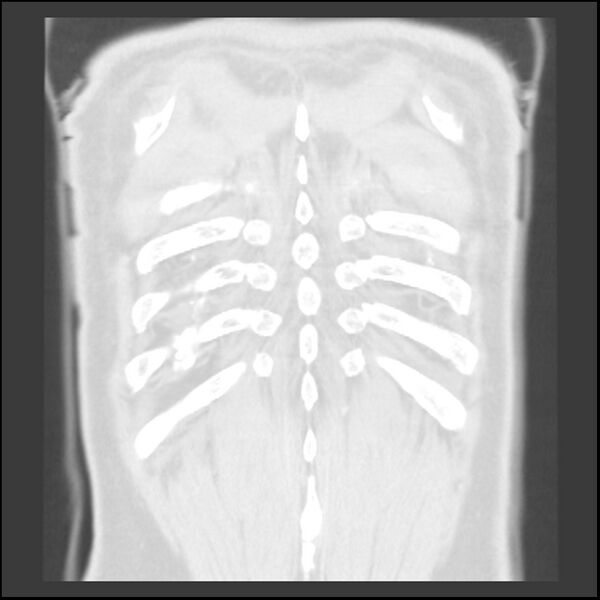 File:Asbestos-related pleural plaques (Radiopaedia 39069-41255 Coronal lung window 5).jpg