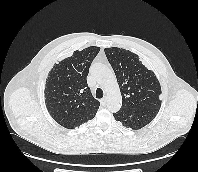 File:Asbestos pleural placques (Radiopaedia 57905-64872 Axial lung window 80).jpg