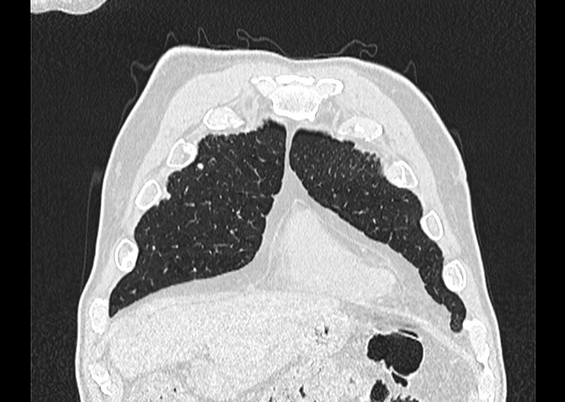 File:Asbestos pleural placques (Radiopaedia 57905-64872 Coronal lung window 33).jpg