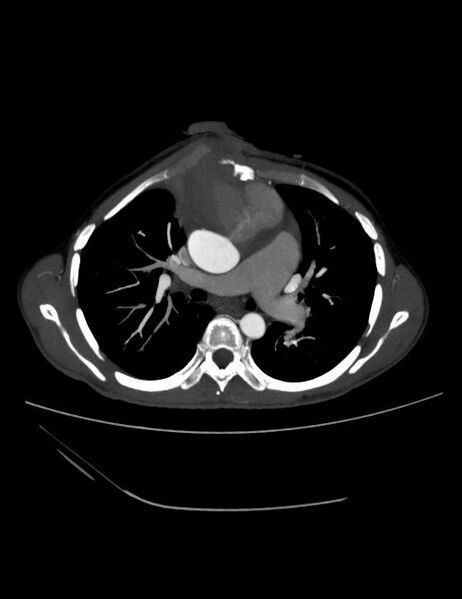 File:Ascending aortic pseudoaneurysm (Radiopaedia 28638-28910 A 10).jpg