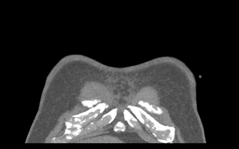 File:Aspirated tooth (Radiopaedia 28584-28844 Coronal C+ CTPA 2).jpg