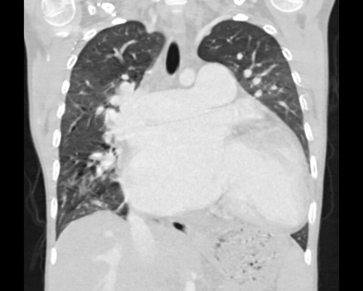 File:Atrial septal defect complicated by Eisenmenger syndrome (Radiopaedia 53707-59768 Sagittal lung window 13).jpg